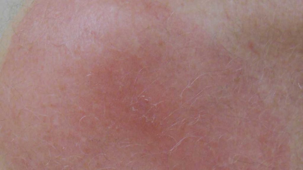 Detection of Lyme Skin Lesions • Johns Hopkins Rheumatology